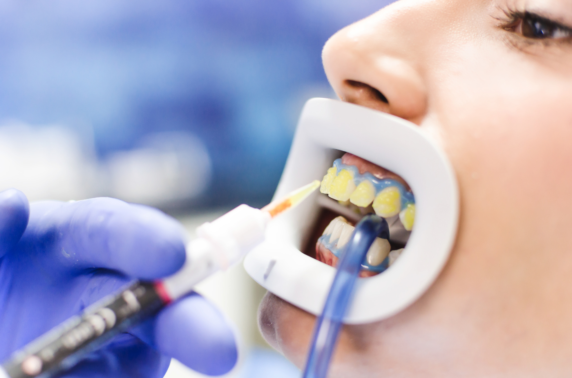 Female patient on teeth bleaching treatment