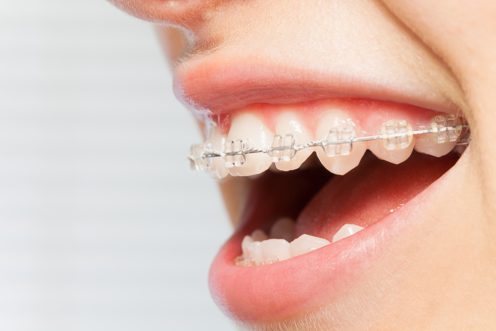 Orthodontics Correction of Jaws with Clear Bracket