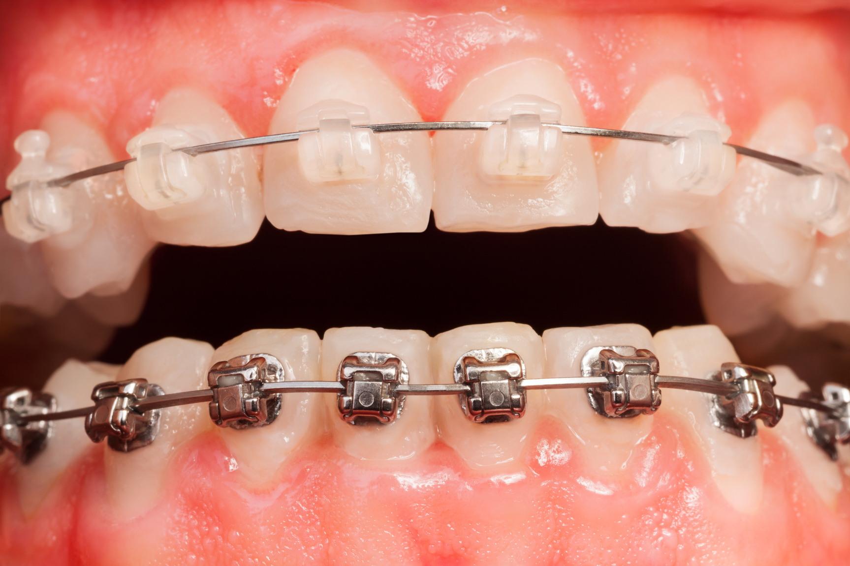 Opened Mouth with Ceramic and Metal Braces