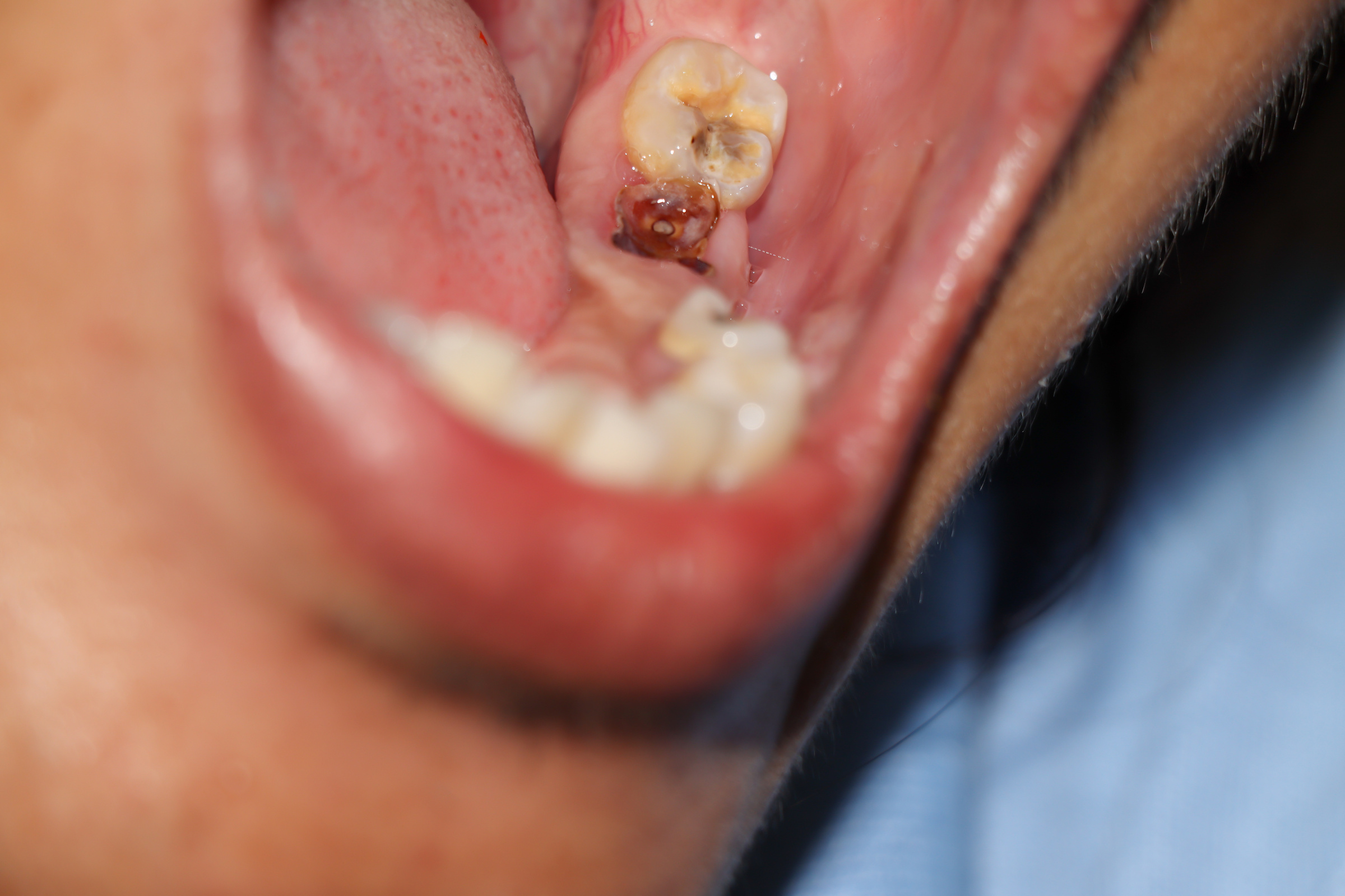 Cavities and broken teeth are painful